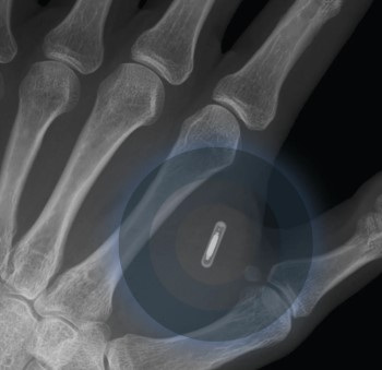 X-ray showing an implanted RFID chip in the hand